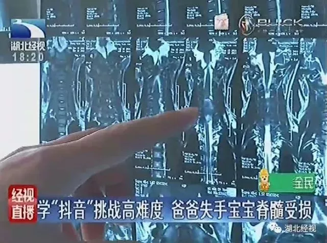 爸爸学“抖音”失手致2岁宝宝头着地脊髓受伤！这些动作千万别模仿！ 5