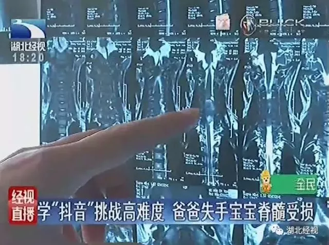 玩“抖音”出事了！2岁宝宝被爸爸180度翻转头部着地、脊髓严重受损……太痛心了！