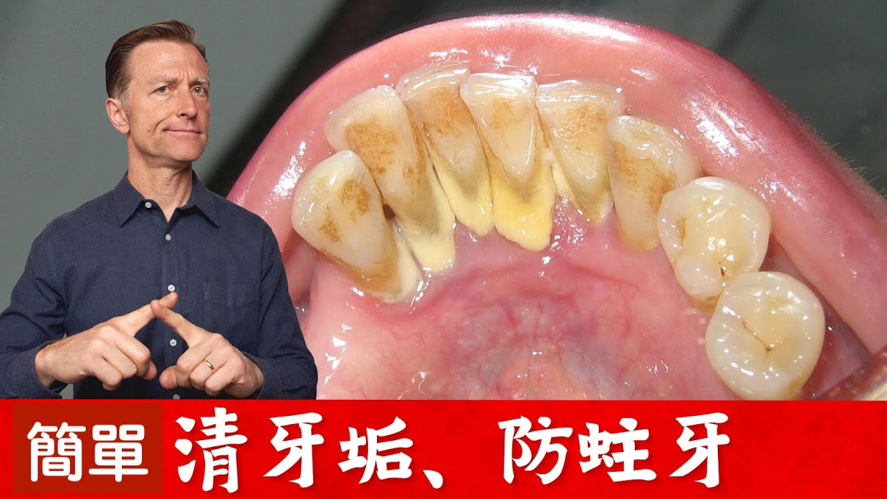 牙垢太多怎么办？三种天然方法去除牙菌斑！