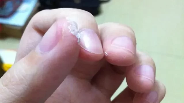 3歲男孩誤食502膠水，醫生忍不住稱讚爸爸的做法 3