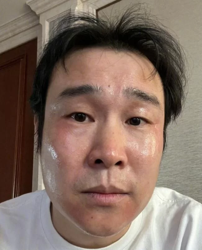 小沈阳也阳了脸部红肿胖了一大圈